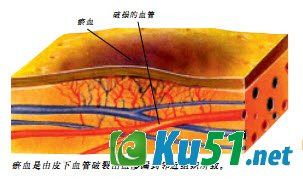 为什么碰伤的皮肤处会有乌青块?