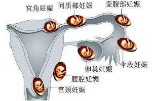不同类型宫外孕的症状表现